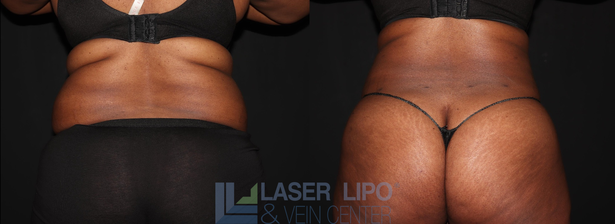 Before and After Image: Liposuction – Back